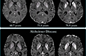 Накопление железа в коре мозга расскажет о болезни Альцгеймера