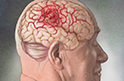 В опухолях головы и шеи нашли генетические «супервключатели»